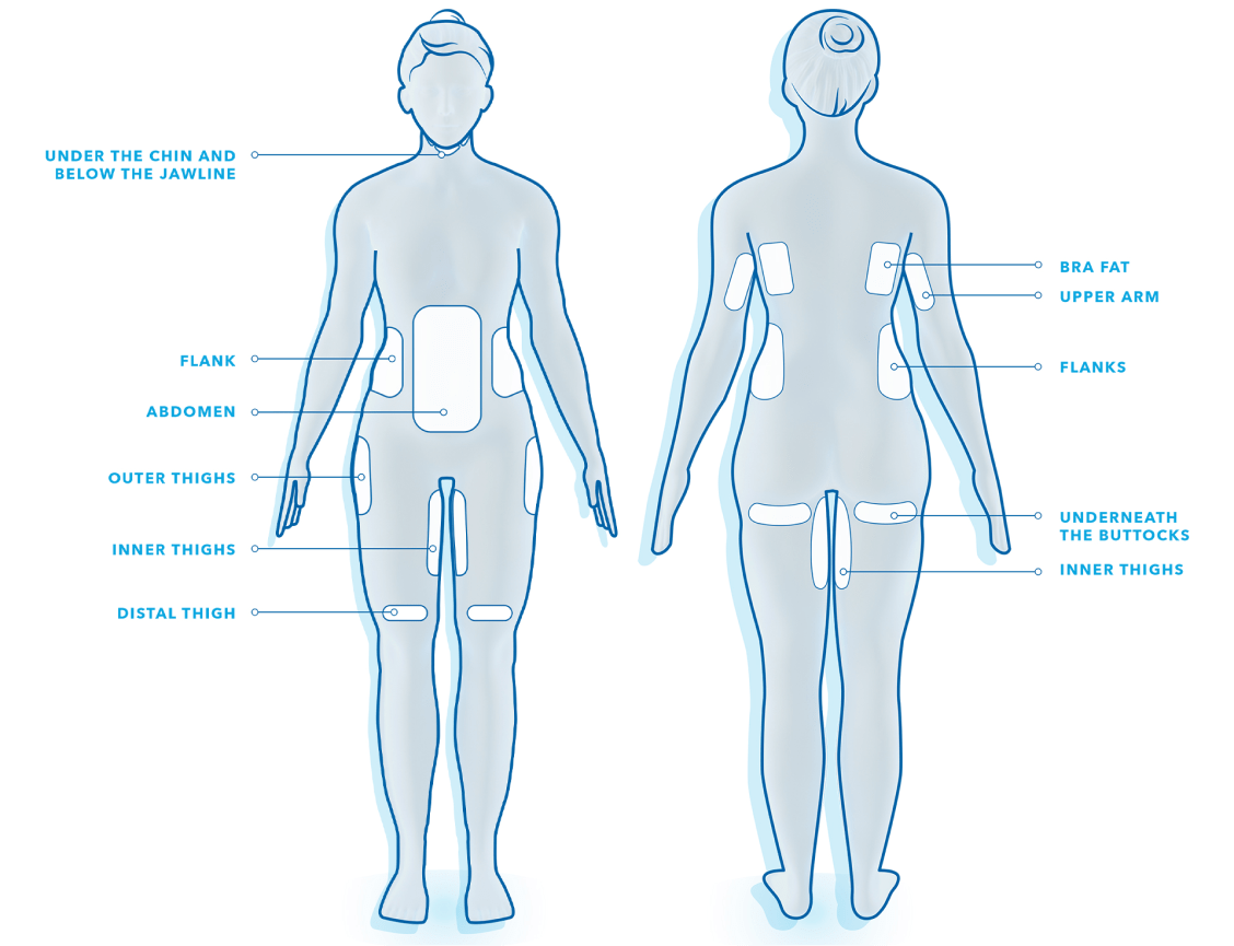 CoolSculpting treatment areas