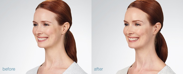 botox cosmetic before and after result