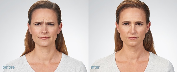 Botox Roswell GA | Dermal Injections