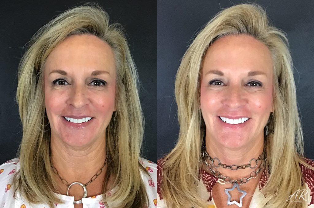 Before and after images of a woman who had dermal fillers on her cheeks and lips