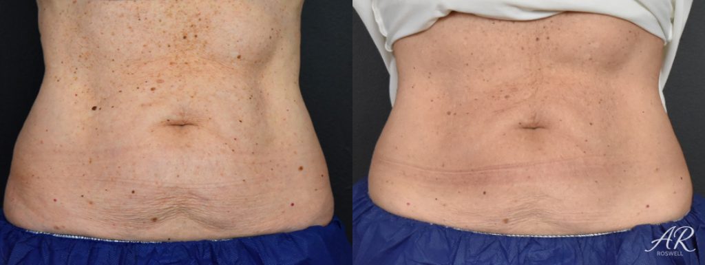 Before and After images of CoolSculpting on a woman's abdomen - front view