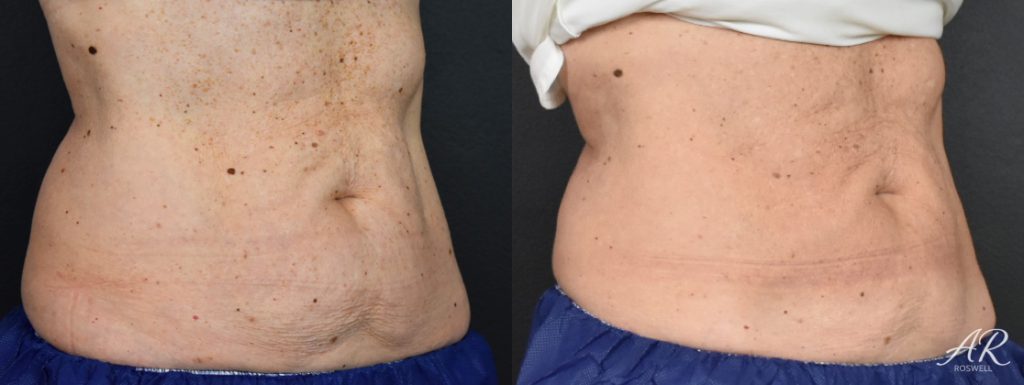 Before and After images of CoolSculpting on a woman's abdomen - front / side view