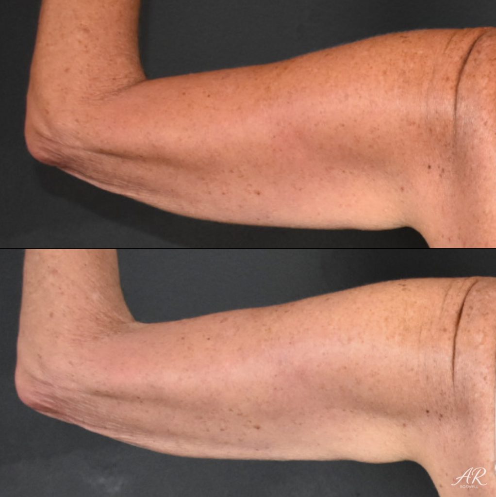 Before and After images of CoolSculpting on a woman's abdomen - back view