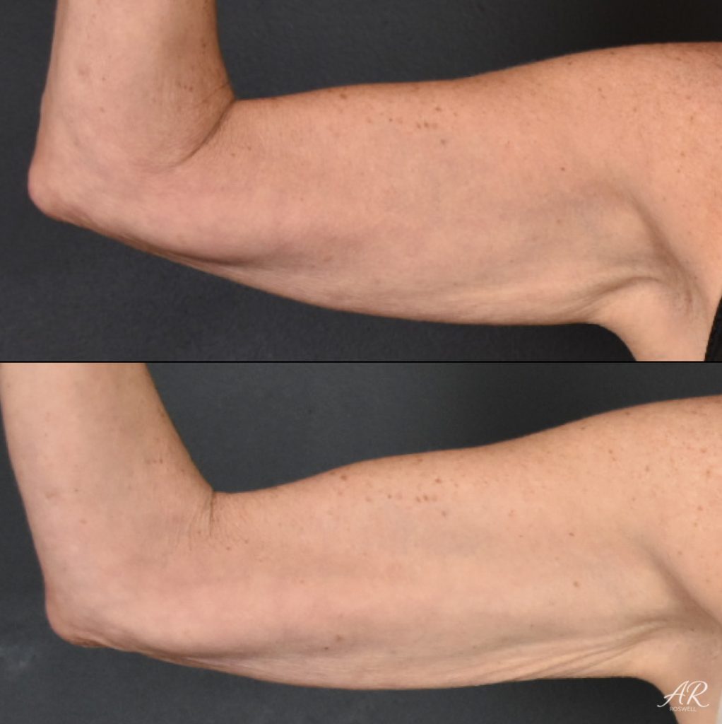 Before and After images of CoolSculpting on a woman's arms - front view