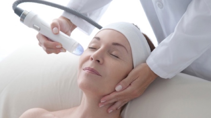Woman receiving Vivace RF Microneedling treatment