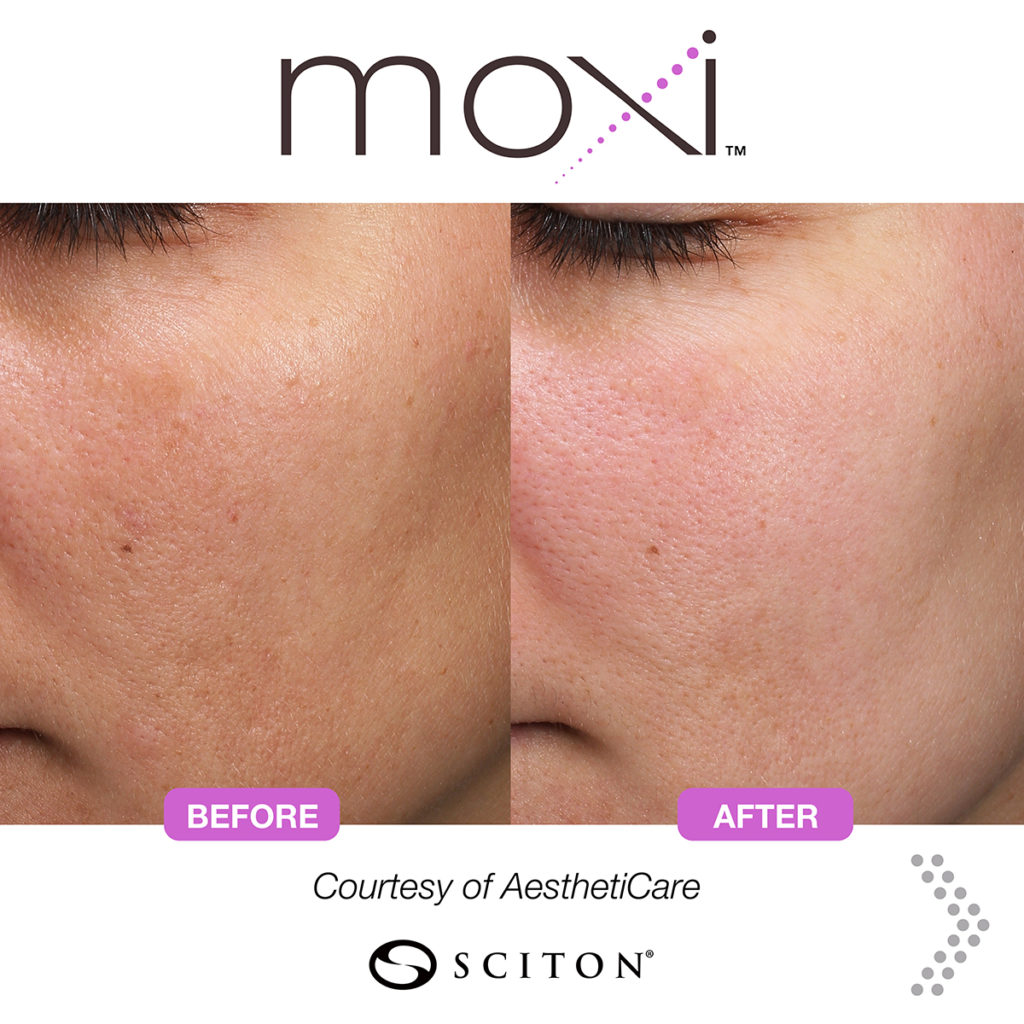 MOXIE before and after pictures