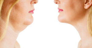What is Ultherapy