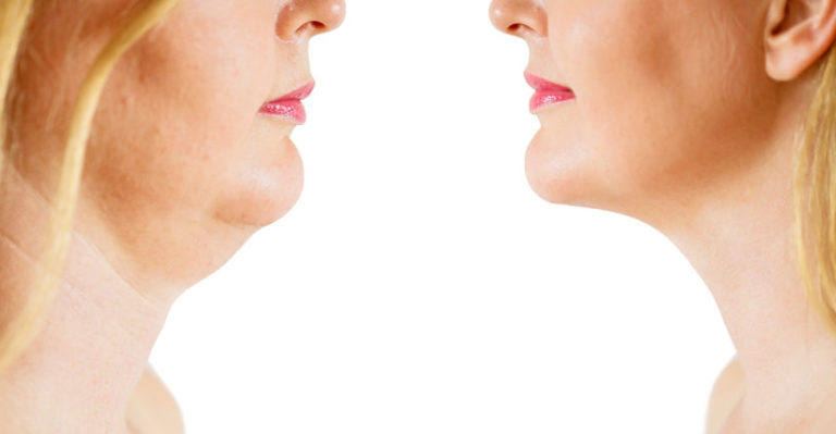 What is Ultherapy