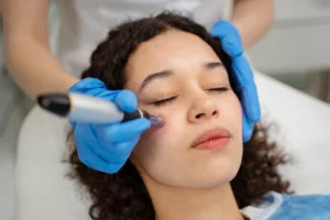 Close-up of a woman receiving a facial treatment with a microneedling device, illustrating the benefits of microneedling and rf microneedling.